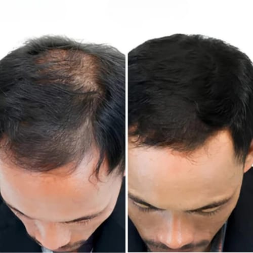HAIR-B™ - Roll-On Révolutionnaire Anti-Chute + Repousse Visible en 21 Jours